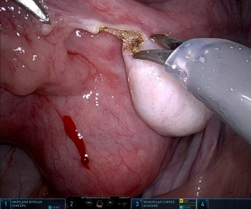 Salpingectomia direita