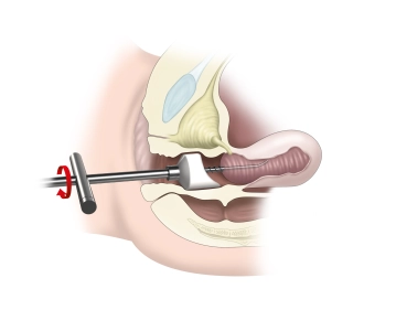 Exame sob anestesia e colocação de um adaptador cervical