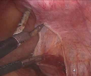 Abertura do retroperitônio