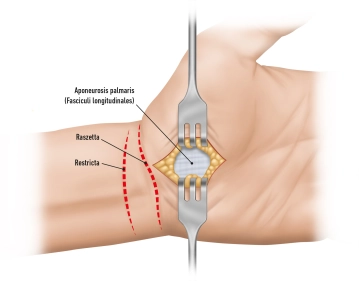 Planejamento/Incisão na Pele 1