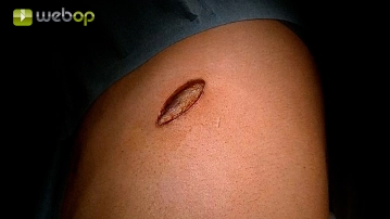 Acesso uniportal VATS e preparação extrapleural