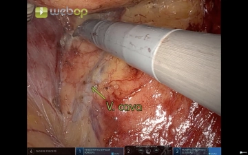 513 4 reversed kocher.jpg