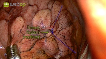 Exploração e marcação do tumor
