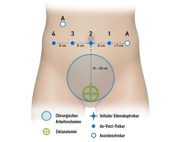 Posicionamento do trocater e acoplamento