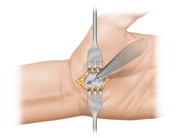 Transecção da Aponeurose Palmar 1