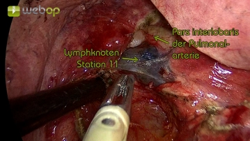 Preparação do interlóbio