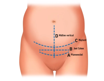 Marcação da linha de incisão