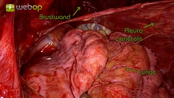 Ressecção da pleura parietal apical