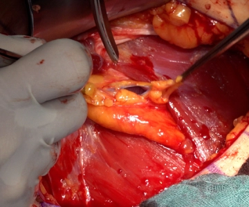 Abertura do Peritônio