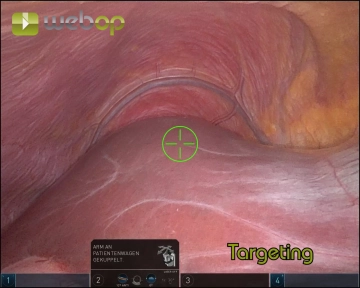 Pneumoperitônio, Colocação de Trocar e Acoplamento 3
