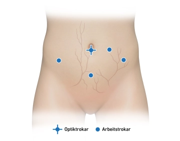 Trocartes de trabalho e inspeção da pelve 1