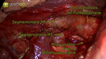 Dissecção da artéria segmentar A8