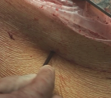 Penetração da Parede Abdominal