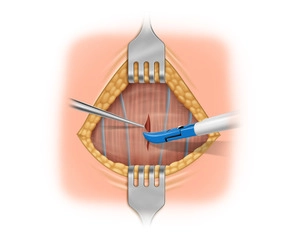 División longitudinal de la musculatura recta del cuello