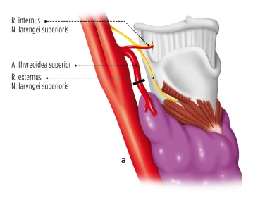 Movilización del polo superior de la tiroides derecho