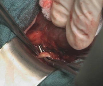 Localización del nervio vago