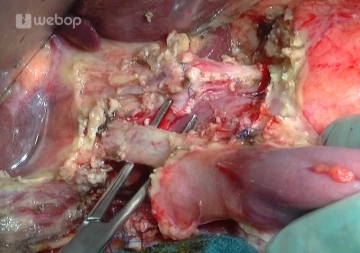 Exploração – Preparação do Ligamentum hepatoduodenale