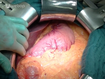 Laparotomia Transversa Abdominal Superior
