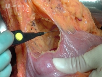 Abertura da Bursa omentalis