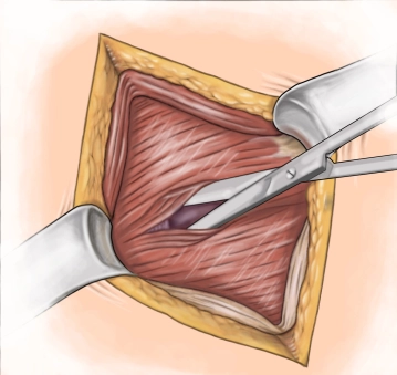 Divisão do músculo