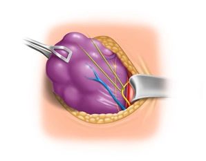 Exposição, Mobilização e Neuromonitoramento do Nervo Vago