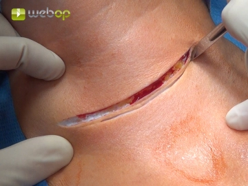 Incisão na Pele/Excisição de Cicatriz