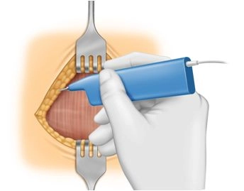Mobilização das Bordas da Ferida