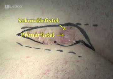 Planejamento da Ressecção