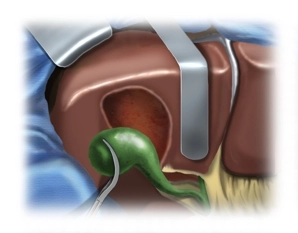 Mobilização da Vesícula Biliar