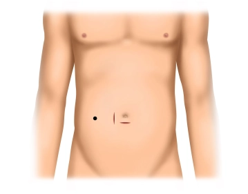 Acesso infraumbilical