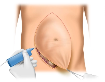 Incisão na pele; excisão da cicatriz