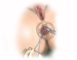 Sutura em bolsa anterior