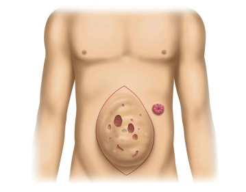 Achados; Incisão Cutânea