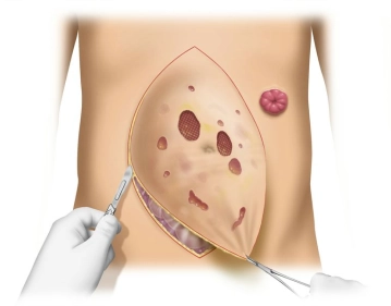 Preparação do Saco Herniário e Exposição do Defeito Herniário