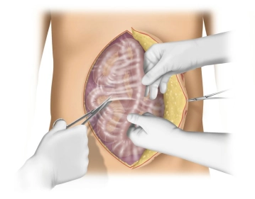 Adesiólise Intra-abdominal