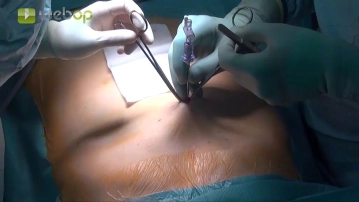 Establecimiento del neumoperitoneo y colocación del trocar óptico