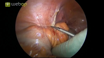 Movilización del sigma desde lateral