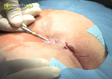 Expondo os seios fistulizantes