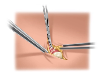 Preparação do Saco Herniário