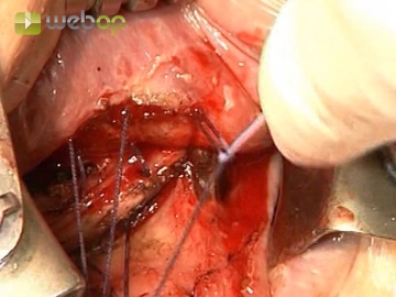 Plicatura de la musculatura