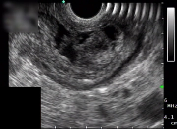 Laparoscopia Exploratória