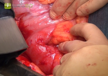 Conversão para Laparotomia