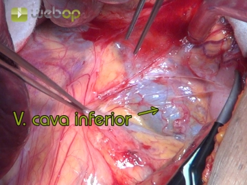 Exposición del retroperitoneo derecho con desplazamiento del hígado hacia craneal y medial