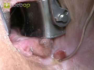 Avaliando a fístula