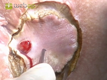 Excisando a abertura externa da fístula