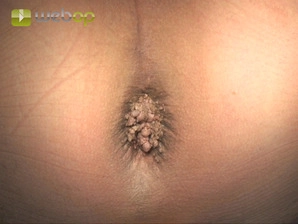 Definición; Fisiopatología