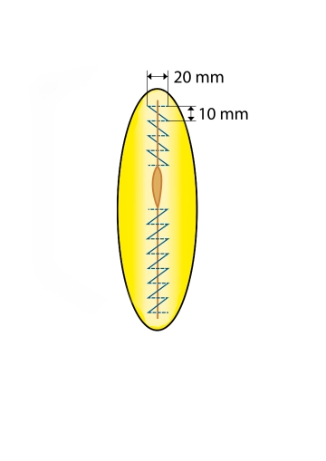 Fechamento fascial contínuo com suturas em loop; sutura inferior