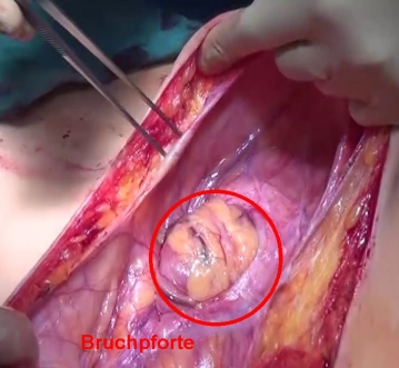 Incisão Cutânea e Abertura do Saco Herniário