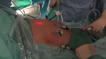 Acessos/Posições dos Trocateres