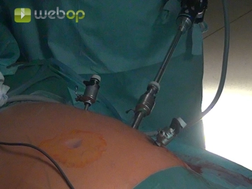 Posicionamento dos Trocars